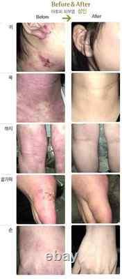 3 Lot of ISAL Atopy Eczema Cream Lotion. /Made in USA