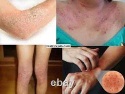 3 Lot of ISAL Atopy Eczema Cream Lotion. /Made in USA