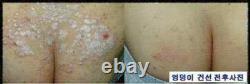 3 Lot of ISAL Atopy Eczema Cream Lotion. /Made in USA